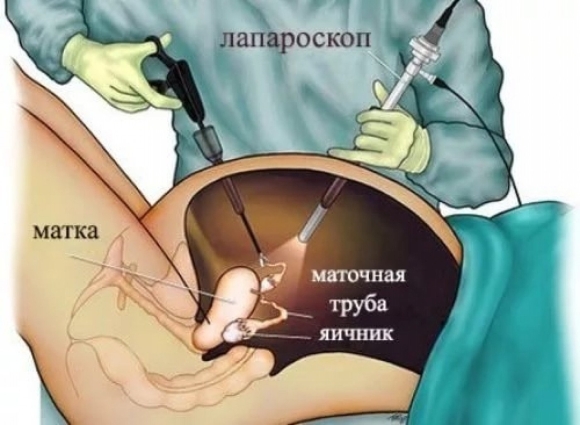 Лапароскопия миомы миомэктомия